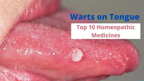 white tag on tongue|genital warts on tongue.